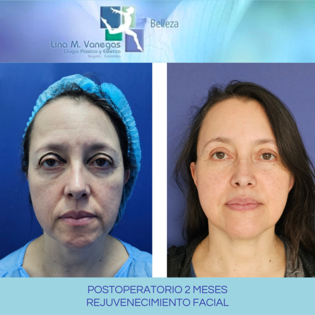 Lifting Facial con Endoscopia, la tendencia actual