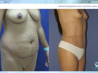 Abdominoplastia - Dermolipectomía