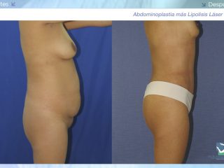 Abdominoplastia - Dermolipectomía