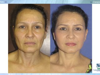 Ritidoplastia – Cirugía de Arrugas Faciales