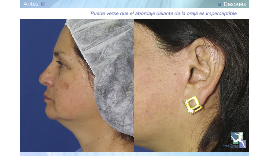 Ritidoplastia – Cirugía de Arrugas Faciales